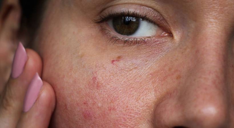 The Misclassification of Skin Irritation Hazards
