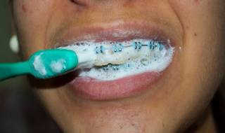 Dental Health Care: How to Brush Teeth with Braces