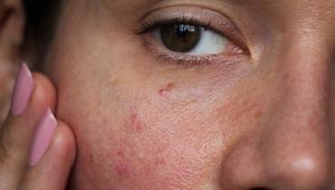 The Misclassification of Skin Irritation Hazards