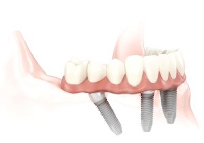 dental-implantjpg.jpeg