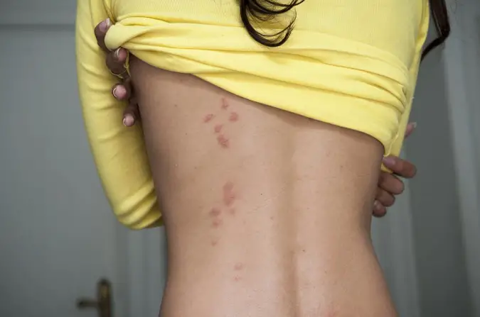 line-of-bedbug-bites-on-a-woman-s-back.jpg